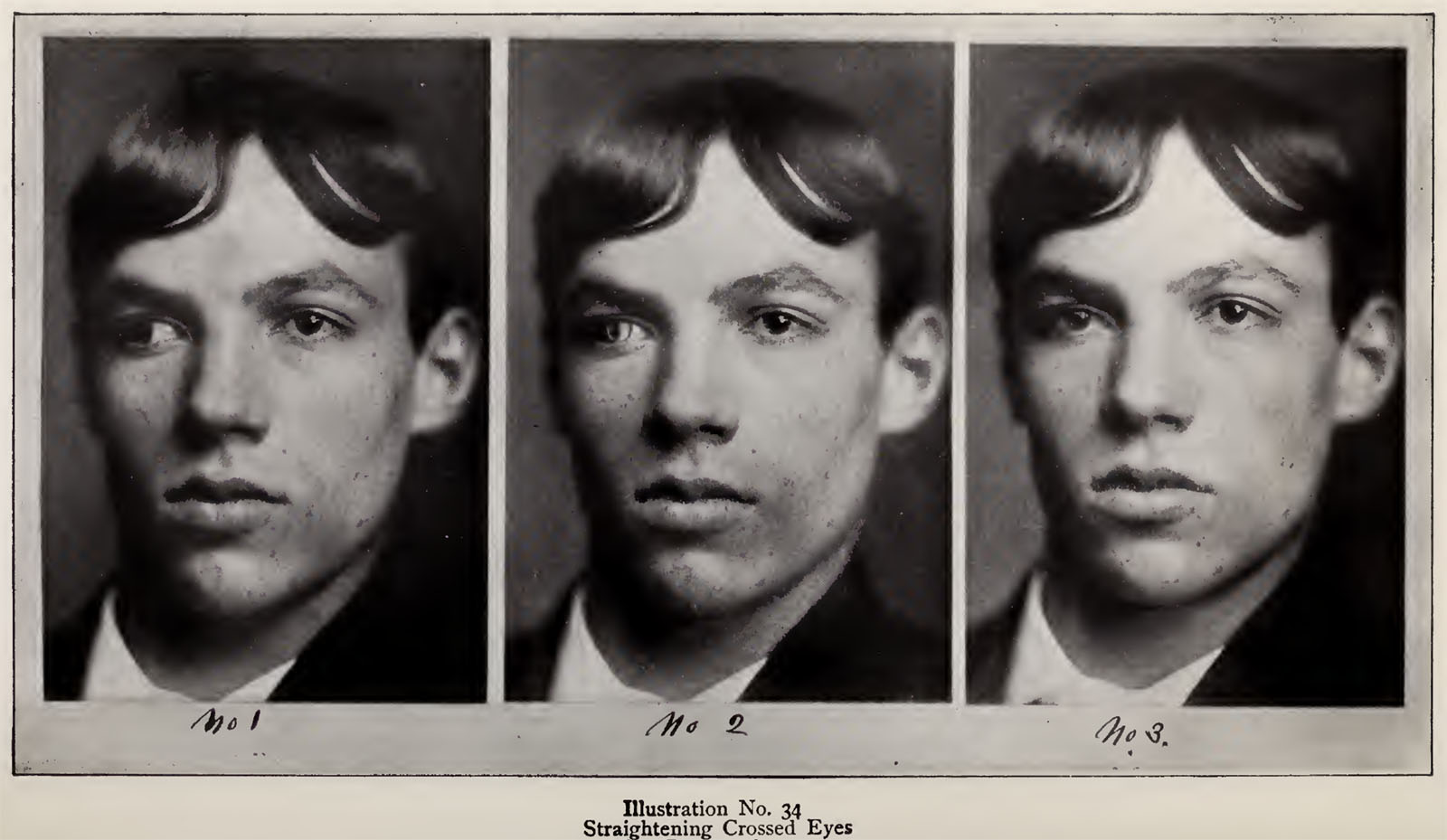 A successive series of three early 20th century portrait photographs featuring man with crossed eyes.