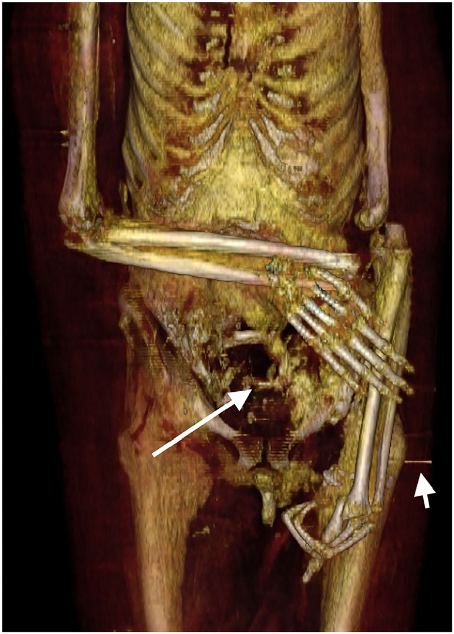 A CT scan of the mummified body of the ancient Egyptian pharaoh Amenhotep I. 